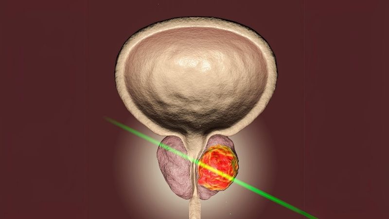 ThuLEP ile Prostat Ameliyatı