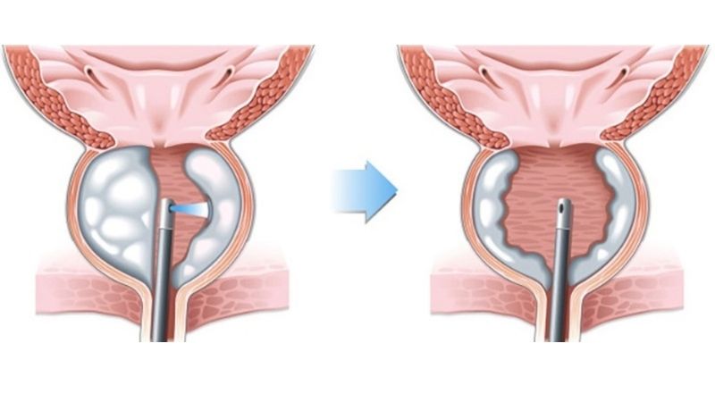 HoLEP ile Prostat Ameliyatı