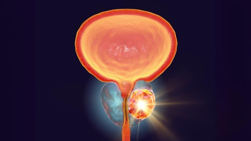Rezum Tedavisi: Prostat Büyümesine Modern Bir Yaklaşım